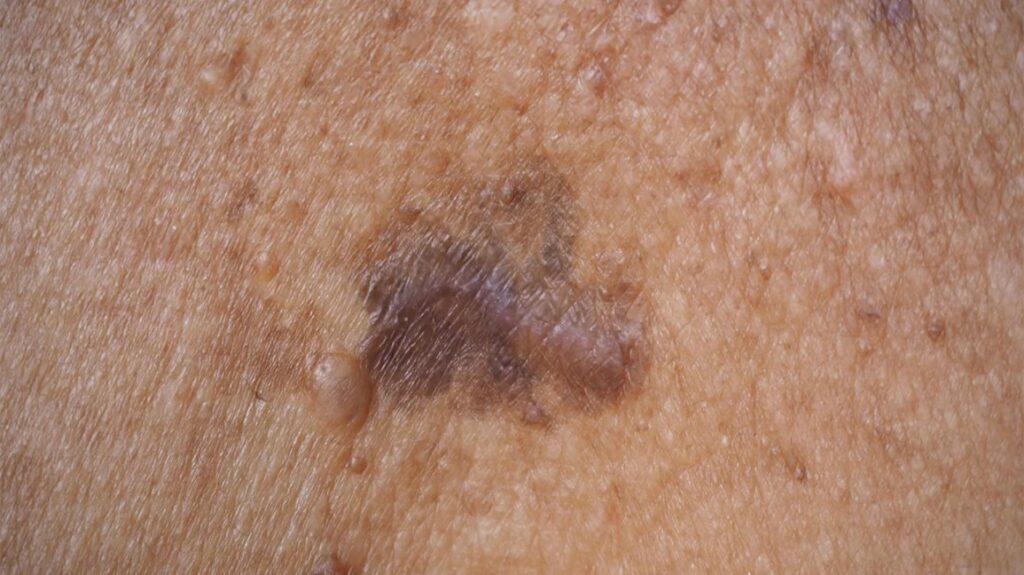 Does Skin Cancer Look Different on Black or Dark Skin? What to Watch For melanoma black skin slide2