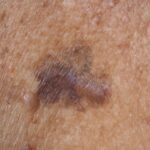 Does Skin Cancer Look Different on Black or Dark Skin? What to Watch For 2 melanoma black skin slide2