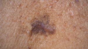 melanoma black skin slide2