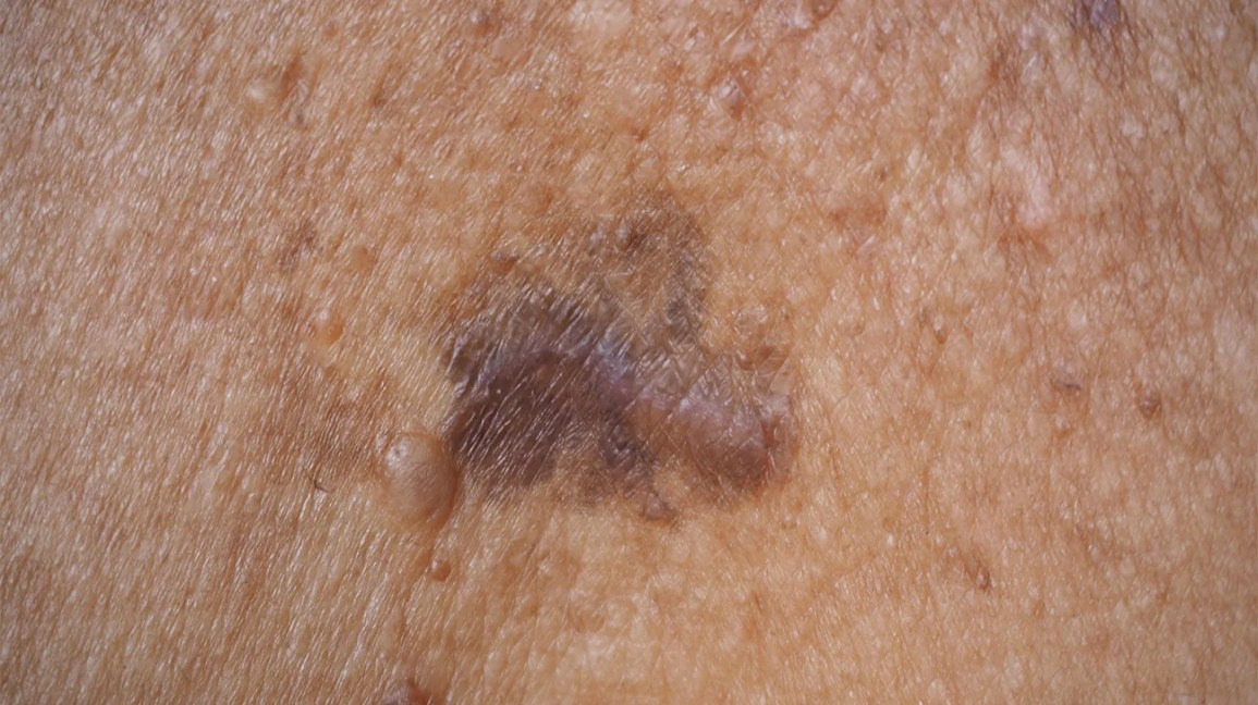Does Skin Cancer Look Different on Black or Dark Skin? What to Watch For
