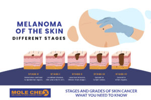 stages and grades of skin cancer what you need to know
