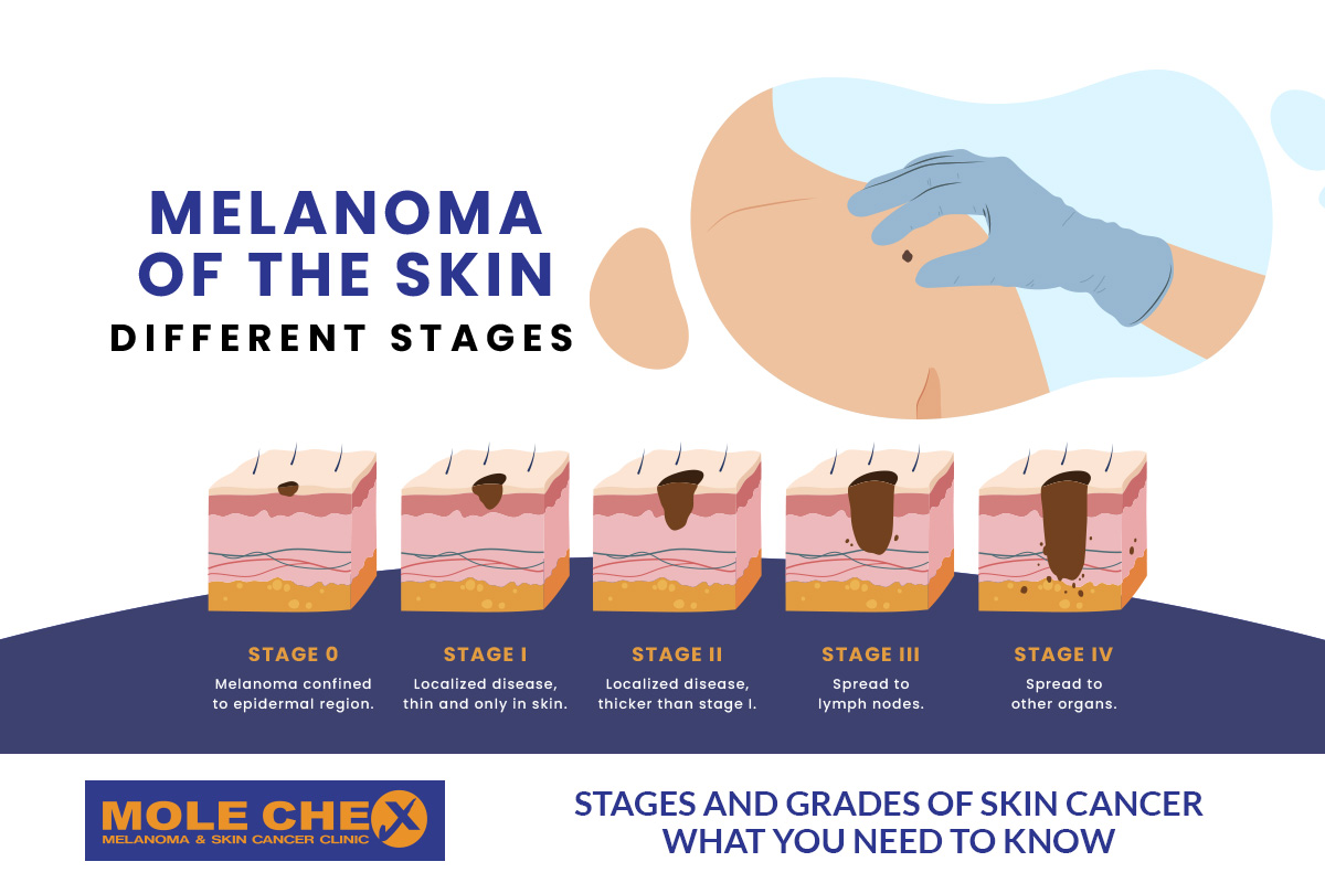 Skin Cancer Stages Explained: From Stage 0 to Stage 4