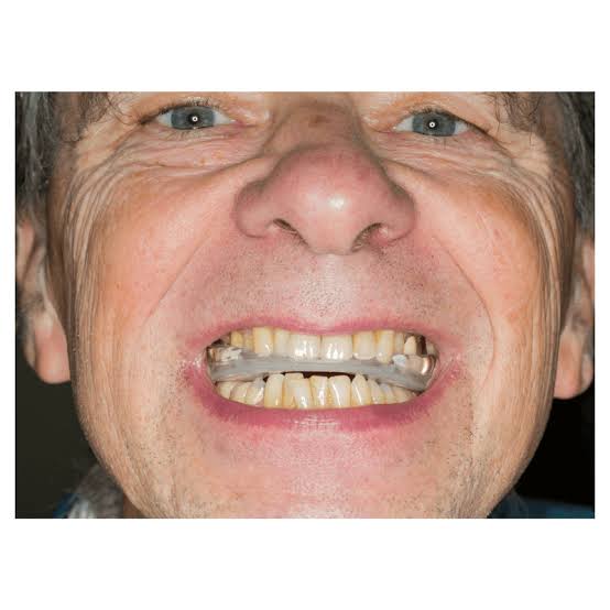 Teeth Grinding in Children, Greenville, SC: Creston Dental & Braces images 11