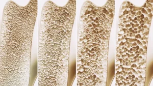 10 Common Myths About Bone Health Debunked
