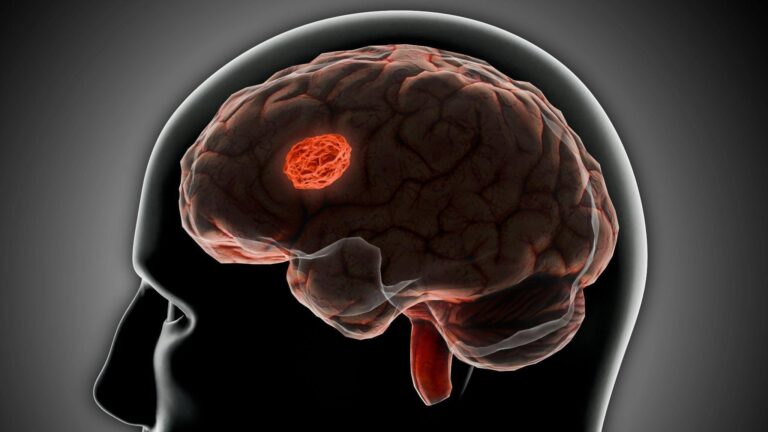 Brenda McGrane’s Insights on Corticobasal Syndrome