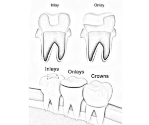 Dental inlays and onlays