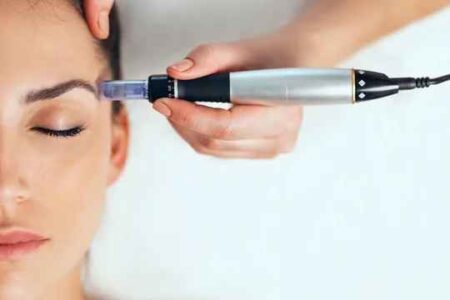 Microneedling For Acne Scars: How It Helps And What To Expect