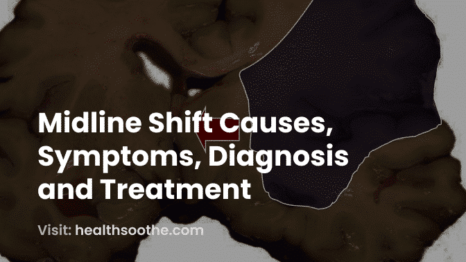 Midline Shift Causes Symptoms Diagnosis And Treatment