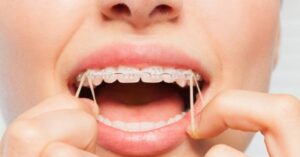 Dental Bands: What They Are and How They Improve Your Braces Treatment