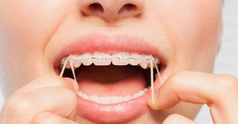 Dental Bands: What They Are and How They Improve Your Braces Treatment 1 Dental Bands: What They Are and How They Improve Your Braces Treatment
